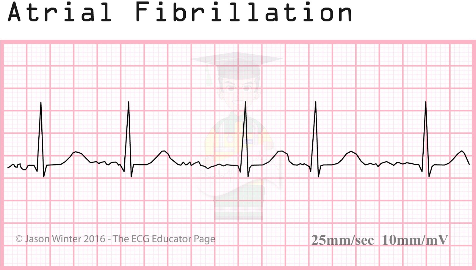 Atrial Fibrillation ECG