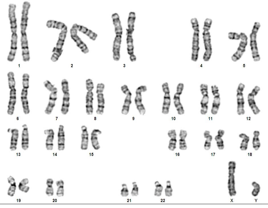 Хромосомы краба. Дифференциальная окраска хромосом. Кариотип методом дифференциальной окраски хромосом. G окрашивание хромосом. Дифференциальное окрашивание хромосом.