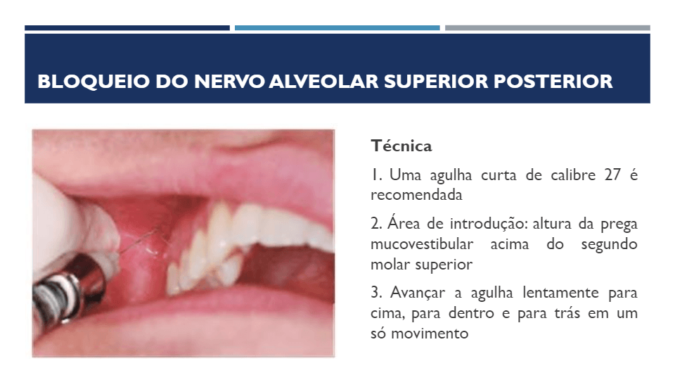 Revis O Bimestre Anestesia Local Odontol Gica Quizizz