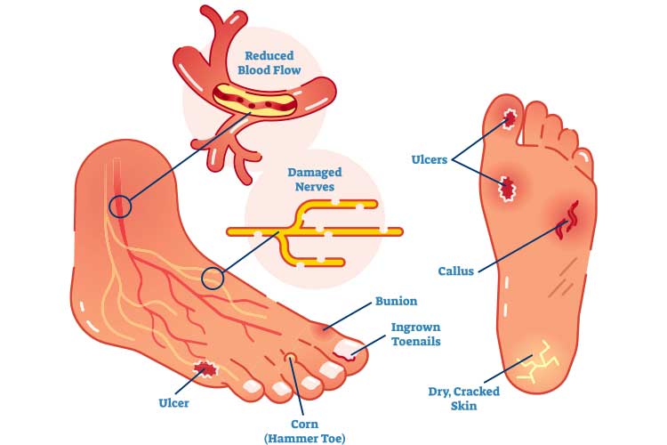 diabetic foot ulcer wagner classification