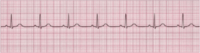 EKG Flashcards - Quizizz