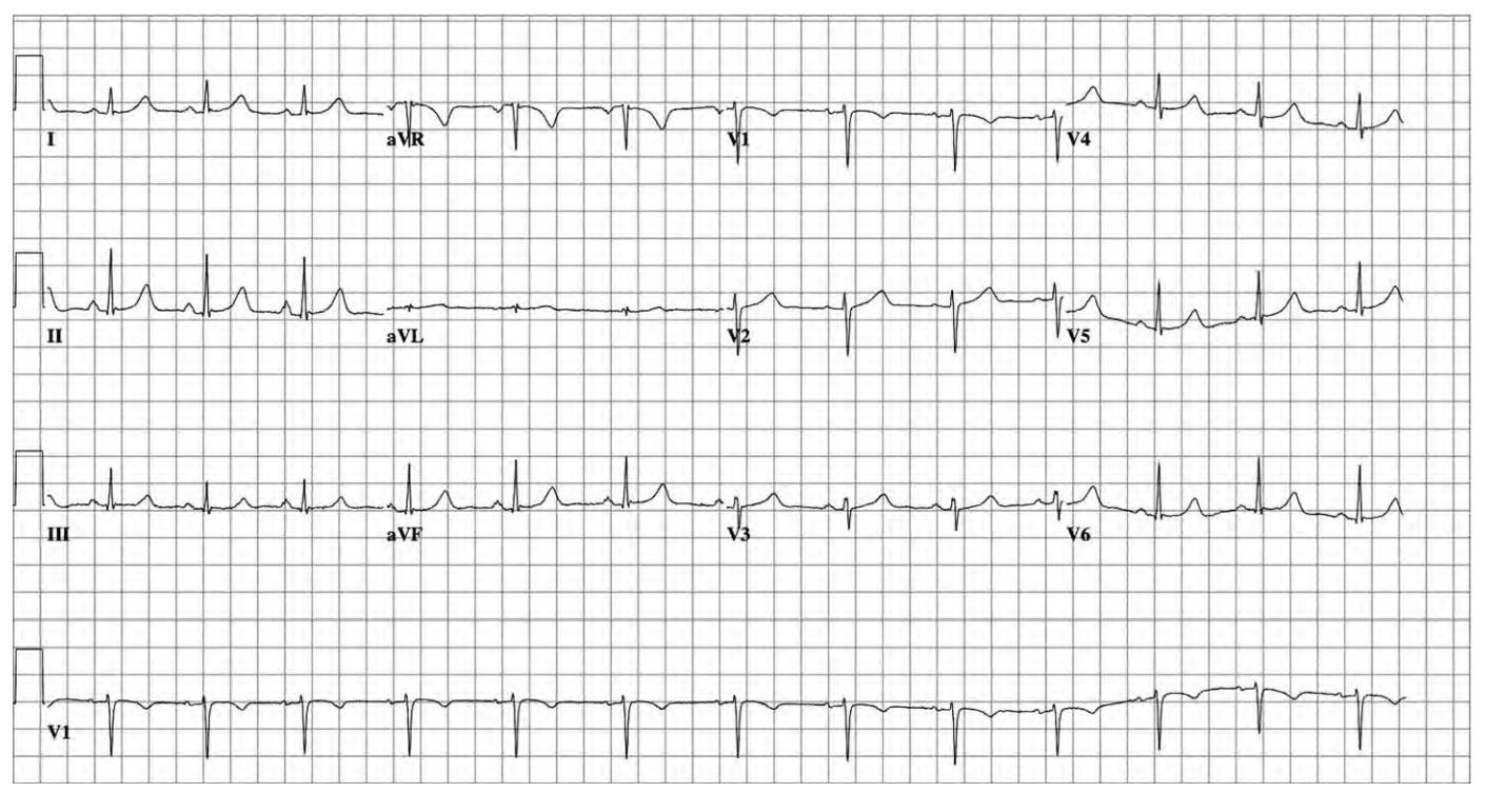 ECG Tarjetas didácticas - Quizizz