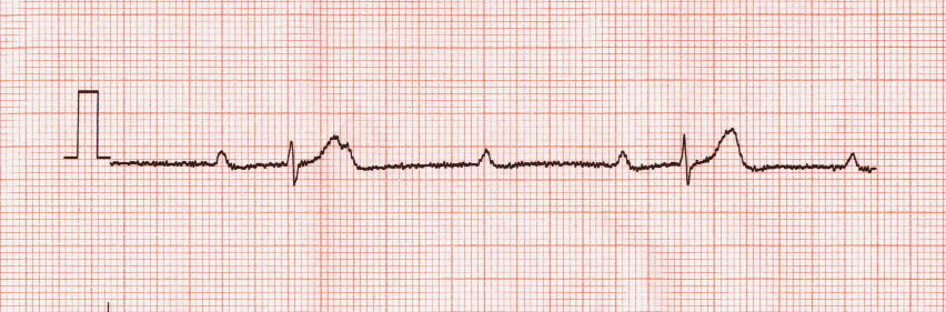 Arrhythmia Quiz