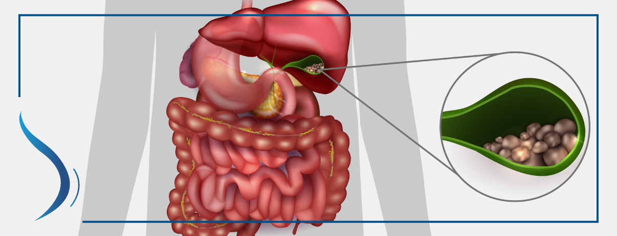 Colecistitis y Coledocolitiasis | Other - Quizizz