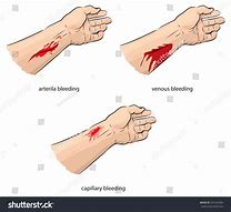 Bleeding And Soft Tissues Injuries | 198 Plays | Quizizz