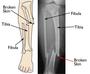 Bone Function & Fractures