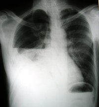 pneumothorax/hemothorax