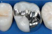 Complex Amalgam Restoration