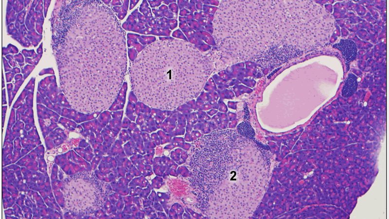 type 1 diabetes pancreas histology