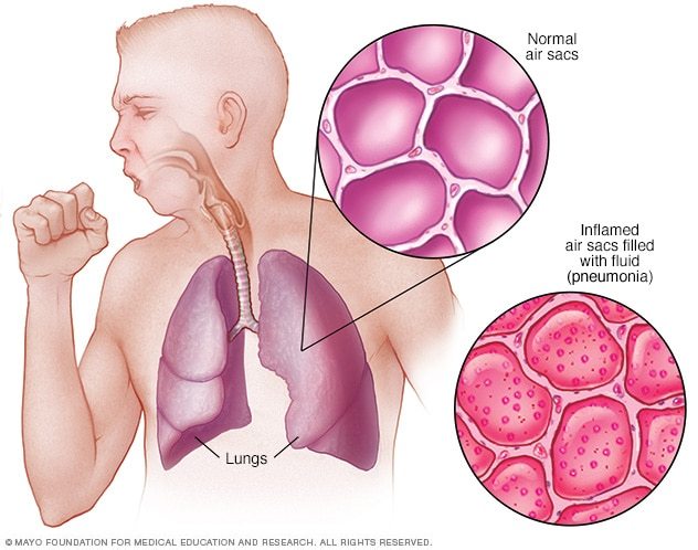 pneumonia-133-plays-quizizz