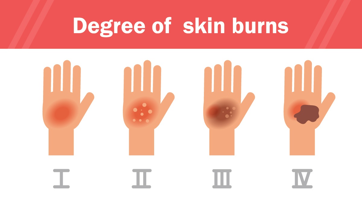 Burns: Classifications and treatment | Other - Quizizz