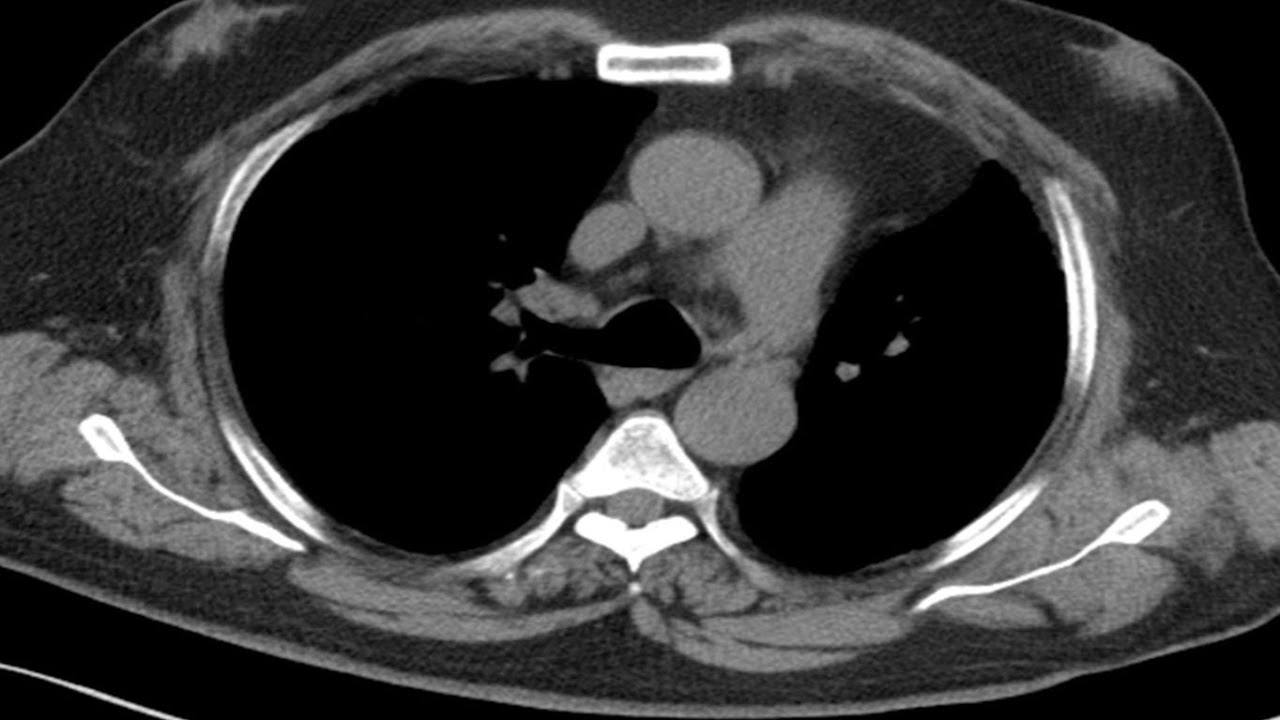 Sectional Anatomy Ct - Thorax 