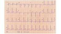 ECG Flashcards - Quizizz