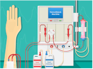 Dialysis is a Well Principled Process! Quiz - Quizizz