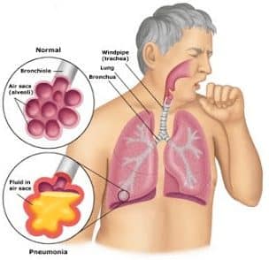 Tenggorokan disebut pada infeksi cabang batang Materi Biologi