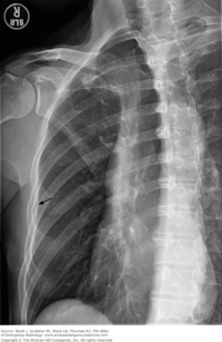 Bony Thorax (Ribs and Sternum) Scenarios 