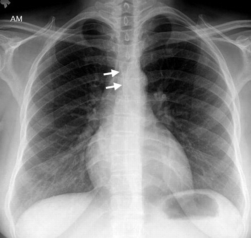 Mediastinal Lines And Stripes 